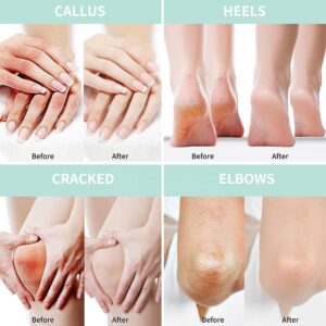 كريم مرطب ومغذي للعناية باليدين والقدمين بحمض الساليسيليك واليوريا